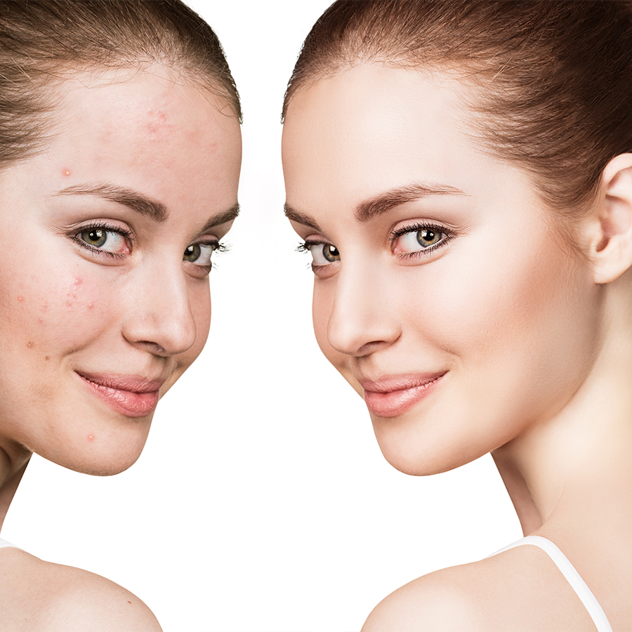 acne-treatment-and-acne-scar-reduction-beauty-within