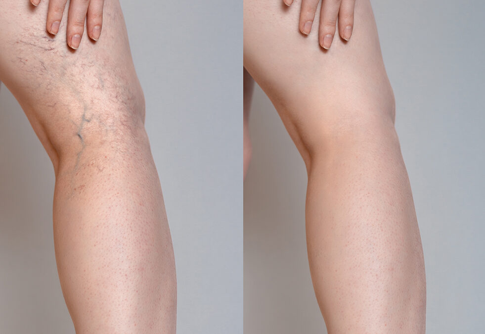 Spider Vein Reduction