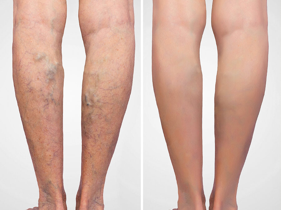 Vein Reduction Sclerotherapy®